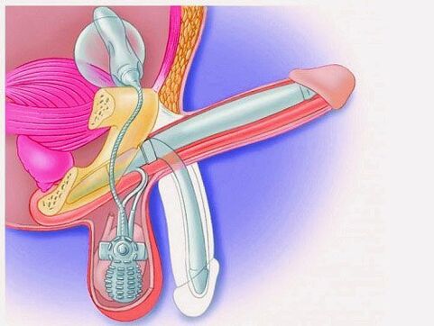 Penis enlargement by penile prosthesis